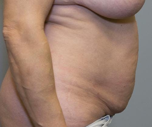 Tummy Tuck Before & After Gallery - Patient 58470207 - Image 3