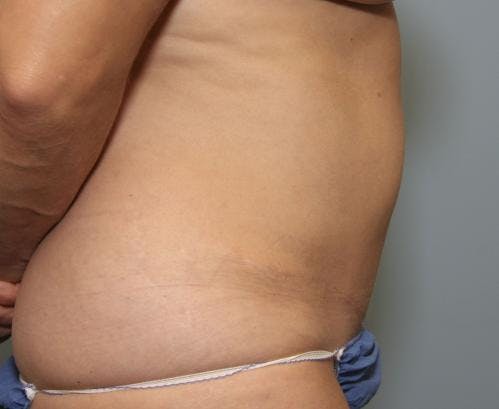 Tummy Tuck Before & After Gallery - Patient 58470207 - Image 4