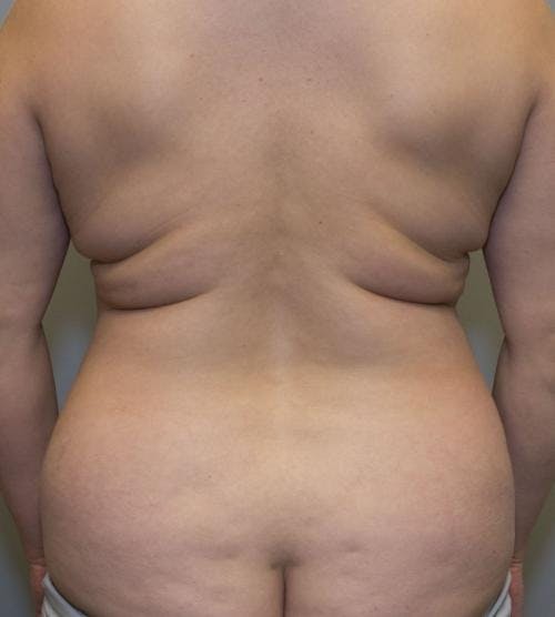 Tummy Tuck Before & After Gallery - Patient 58470207 - Image 5
