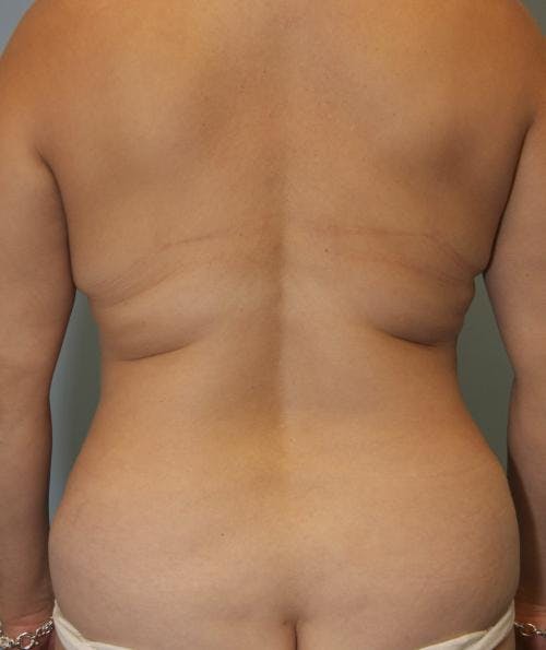 Tummy Tuck Before & After Gallery - Patient 58470207 - Image 6