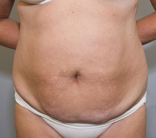 Tummy Tuck Before & After Gallery - Patient 58470208 - Image 1