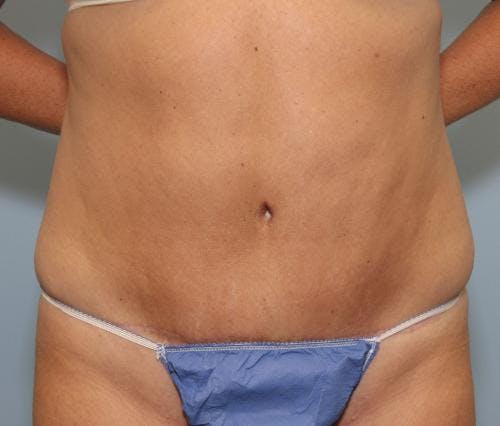 Tummy Tuck Before & After Gallery - Patient 58470208 - Image 2