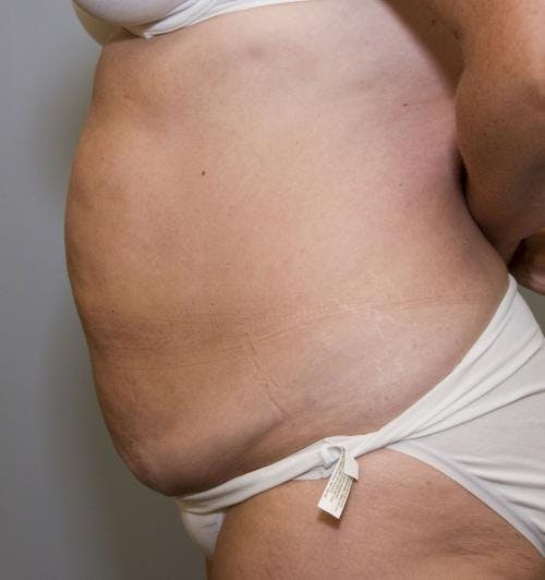 Tummy Tuck Before & After Gallery - Patient 58470208 - Image 3