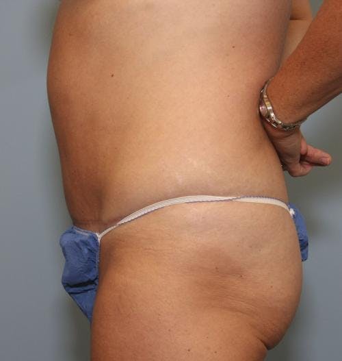 Tummy Tuck Before & After Gallery - Patient 58470208 - Image 4