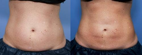 Body Before & After Gallery - Patient 58470257 - Image 1