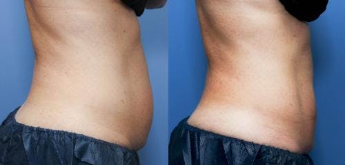 Body Before & After Gallery - Patient 58470257 - Image 3