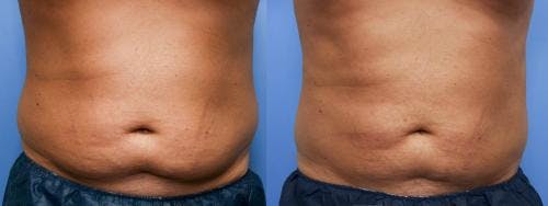 Body Before & After Gallery - Patient 58470258 - Image 1