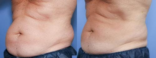 Body Before & After Gallery - Patient 58470259 - Image 2