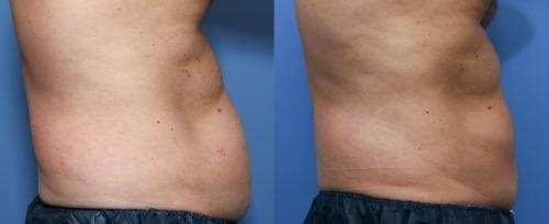 Body Before & After Gallery - Patient 58470259 - Image 3