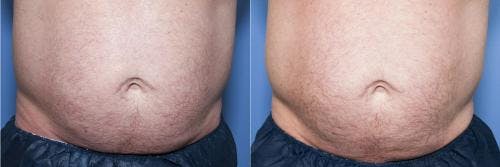 Body Before & After Gallery - Patient 58470260 - Image 3
