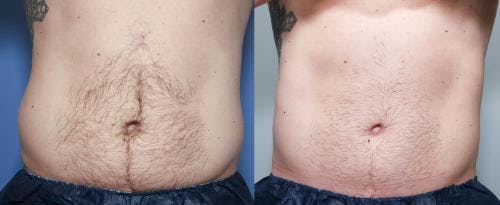 Body Before & After Gallery - Patient 58470261 - Image 1
