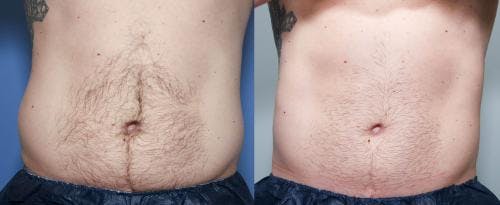 Body Before & After Gallery - Patient 58470261 - Image 1