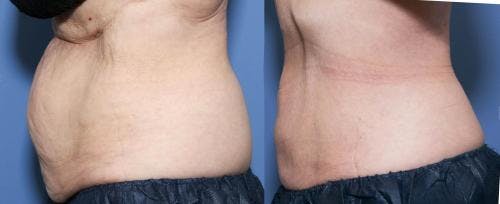 Body Before & After Gallery - Patient 58470283 - Image 2