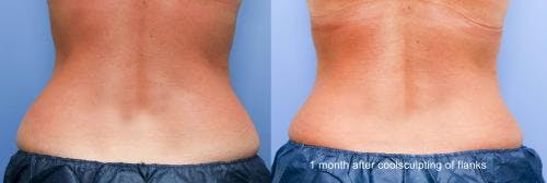 Body Before & After Gallery - Patient 58470285 - Image 1