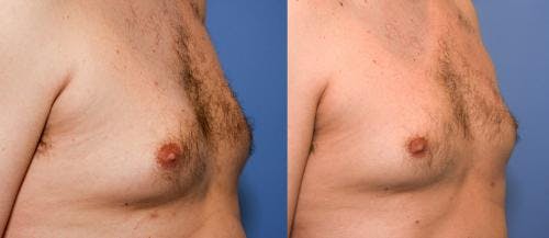 Body Before & After Gallery - Patient 58470286 - Image 2