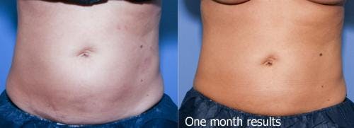 Body Before & After Gallery - Patient 58470287 - Image 1