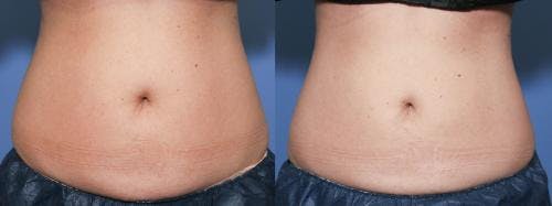 Body Before & After Gallery - Patient 58470288 - Image 1