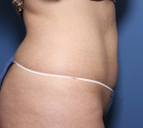 Body Before & After Gallery - Patient 58470291 - Image 4