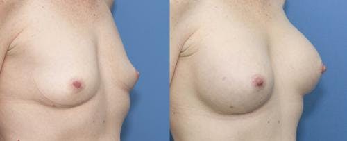 Breast Augmentation Before & After Gallery - Patient 58470344 - Image 2