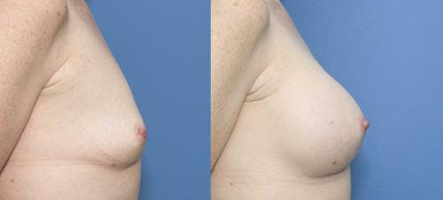 Breast Augmentation Before & After Gallery - Patient 58470344 - Image 3