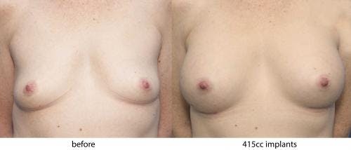 Breast Augmentation Before & After Gallery - Patient 58470344 - Image 1