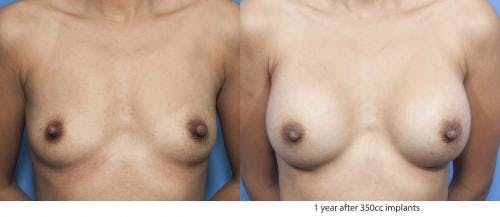 Breast Augmentation Before & After Gallery - Patient 58470347 - Image 1
