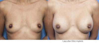 Breast Augmentation Before & After Gallery - Patient 58470347 - Image 1