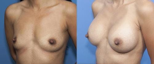 Breast Augmentation Before & After Gallery - Patient 58470347 - Image 2