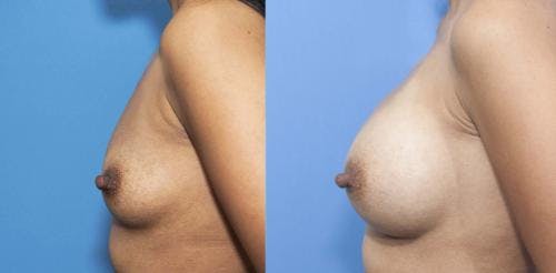 Breast Augmentation Before & After Gallery - Patient 58470347 - Image 3
