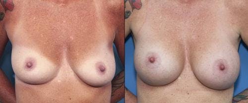 Breast Augmentation Before & After Gallery - Patient 58470348 - Image 1