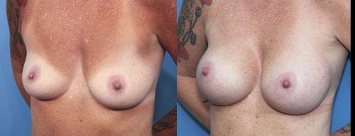 Breast Augmentation Before & After Gallery - Patient 58470348 - Image 2