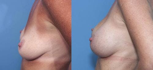 Breast Augmentation Before & After Gallery - Patient 58470348 - Image 3