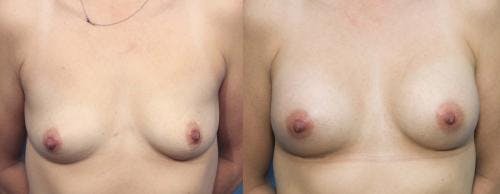 Breast Augmentation Before & After Gallery - Patient 58470350 - Image 1