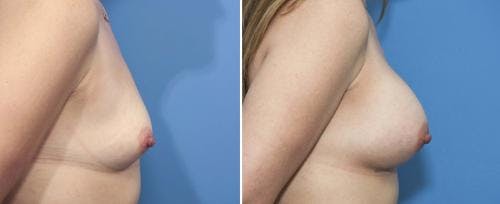 Breast Augmentation Before & After Gallery - Patient 58470350 - Image 2