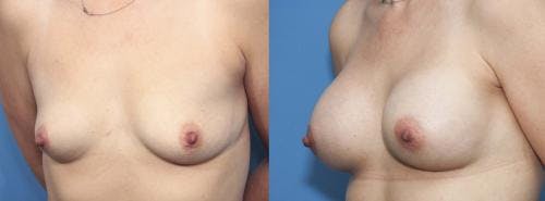 Breast Augmentation Before & After Gallery - Patient 58470350 - Image 3