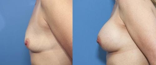 Breast Augmentation Before & After Gallery - Patient 58470350 - Image 4