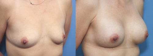 Breast Augmentation Before & After Gallery - Patient 58470350 - Image 5