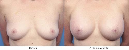 Breast Augmentation Before & After Gallery - Patient 58470352 - Image 1