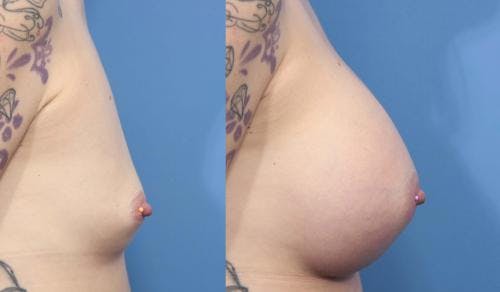 Breast Augmentation Before & After Gallery - Patient 58470352 - Image 3