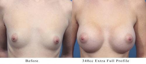 Breast Augmentation Before & After Gallery - Patient 58470353 - Image 1