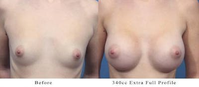 Breast Augmentation Before & After Gallery - Patient 58470353 - Image 1
