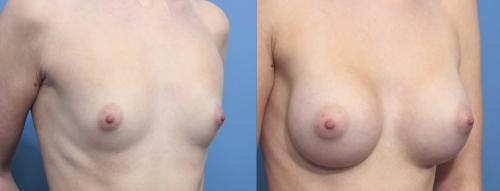 Breast Augmentation Before & After Gallery - Patient 58470353 - Image 2