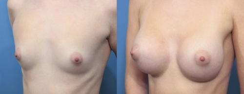 Breast Augmentation Before & After Gallery - Patient 58470353 - Image 3