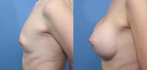 Breast Augmentation Before & After Gallery - Patient 58470353 - Image 4
