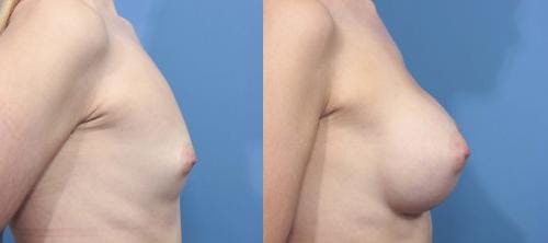 Breast Augmentation Before & After Gallery - Patient 58470353 - Image 5