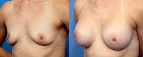 Breast Augmentation Before & After Gallery - Patient 58470354 - Image 1
