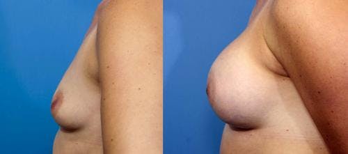 Breast Augmentation Before & After Gallery - Patient 58470354 - Image 2