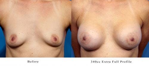 Breast Augmentation Before & After Gallery - Patient 58470354 - Image 3