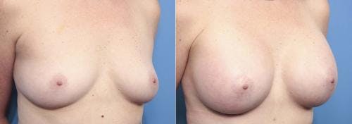 Breast Augmentation Before & After Gallery - Patient 58470355 - Image 1