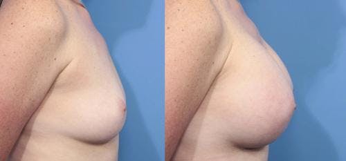 Breast Augmentation Before & After Gallery - Patient 58470355 - Image 3